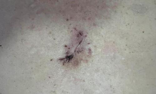皮脂腺囊肿手术视频,皮脂腺囊肿手术全过程解析
