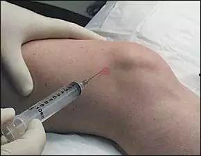 膝关节注射视频教程,膝关节注射操作步骤详解教程
