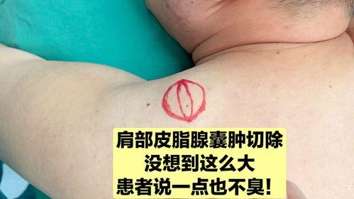 皮脂腺囊肿切除视频,皮脂腺囊肿切除手术过程详解